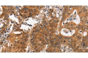 Immunohistochemistry of paraffin-embedded Human gastic cancer using ITGA2 Polyclonal Antibody at dilution of 1:30 (ITGA2 Antikörper)