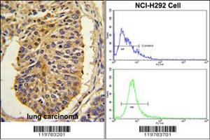 (LEFT)Formalin-fixed and paraffin-embedded human lung carcinoma with CER1 Antibody (N-term), which was peroxidase-conjugated to the secondary antibody, followed by DAB staining.
