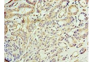 Immunohistochemistry of paraffin-embedded human breast cancer using ABIN7142902 at dilution of 1:100 (AKAP1 Antikörper  (AA 413-662))