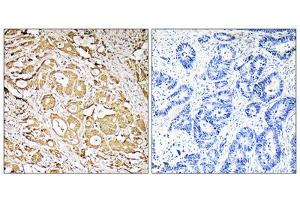Immunohistochemistry analysis of paraffin-embedded human colon carcinoma tissue, using MRPS7 antibody. (FUT3 Antikörper  (Internal Region))
