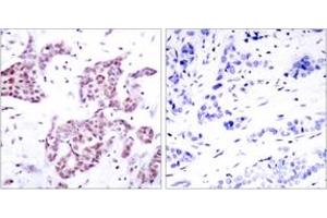 Immunohistochemistry analysis of paraffin-embedded human breast carcinoma, using STAT6 (Phospho-Tyr641) Antibody. (STAT6 Antikörper  (pTyr641))