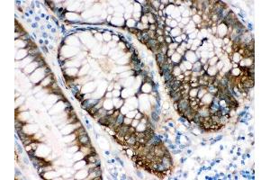 IHC analysis of IDH1 using anti-IDH1 antibody (ABIN3043855).