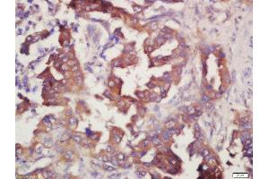 Formalin-fixed and paraffin embedded human lung carcinoma labeled with Rabbit Anti-Prostaglandin E Receptor EP4 Polyclonal Antibody, Unconjugated (ABIN1387963) at 1:200 followed by conjugation to the secondary antibody and DAB staining (PTGER4 Antikörper  (AA 151-250))