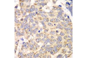Immunohistochemistry of paraffin-embedded human esophageal cancer using HAGH antibody at dilution of 1:100 (x40 lens). (HAGH Antikörper)