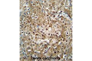 CF153 antibody (C-term) immunohistochemistry analysis in formalin fixed and paraffin embedded human cervix carcinoma followed by peroxidase conjugation of the secondary antibody and DAB staining. (CF153 (AA 233-263), (C-Term) Antikörper)
