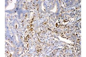IHC testing of FFPE human rectal cancer tissue with Psoriasin antibody at 1ug/ml. (S100A7 Antikörper)