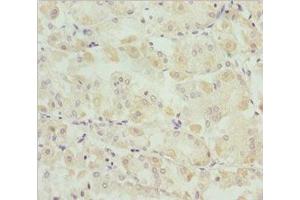 Immunohistochemistry of paraffin-embedded human gastric cancer using ABIN7171149 at dilution of 1:100 (SNAP29 Antikörper  (AA 1-258))