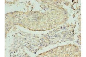 Immunohistochemistry of paraffin-embedded human lung cancer using ABIN7164305 at dilution of 1:100 (Neuregulin 2 Antikörper  (AA 112-405))