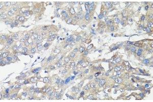 Immunohistochemistry of paraffin-embedded Human liver cancer using MUL1 Polyclonal Antibody at dilution of 1:100 (40x lens). (MUL1 Antikörper)