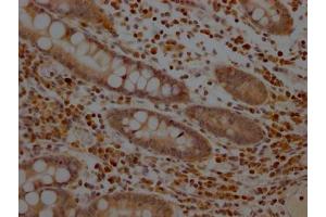 IHC image of ABIN7127612 diluted at 1:100 and staining in paraffin-embedded human colon cancer performed on a Leica BondTM system. (Rekombinanter MEK1 Antikörper)