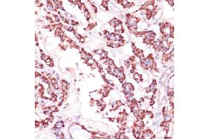 Immunohistochemistry of paraffin-embedded human thyroid cancer using RPL24 antibody (ABIN7269998) at dilution of 1:100 (40x lens). (RPL24 Antikörper  (AA 38-157))