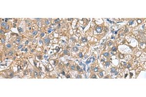 Immunohistochemistry of paraffin-embedded Human liver cancer tissue using IGLL1 Polyclonal Antibody at dilution of 1:65(x200) (IGLL1 Antikörper)