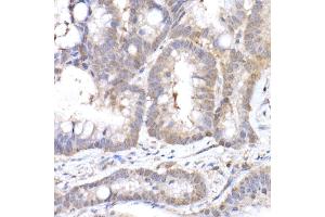 Immunohistochemistry of paraffin-embedded human colon carcinoma using MTAP Rabbit mAb (ABIN7268498) at dilution of 1:50 (40x lens). (MTAP Antikörper)