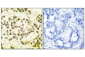 Immunohistochemical analysis of paraffin-embedded human breast carcinoma tissue using STAT5B (phospho-Ser731) antibody. (STAT5B Antikörper  (pSer731))