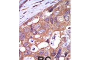 Formalin-fixed and paraffin-embedded human cancer tissue reacted with the primary antibody, which was peroxidase-conjugated to the secondary antibody, followed by AEC staining. (PKC mu Antikörper  (N-Term))