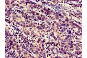 Immunohistochemistry of paraffin-embedded human pancreatic cancer using ABIN7158447 at dilution of 1:100 (LOXHD1 Antikörper  (AA 1101-1366))