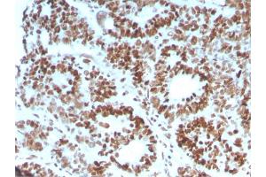 Formalin-fixed, paraffin-embedded human Colon Carcinoma stained with MSH6 Mouse Monoclonal Antibody (MSH6/3086). (MSH6 Antikörper  (AA 374-540))