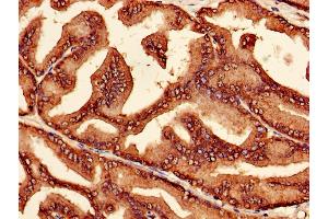 Immunohistochemistry of paraffin-embedded human prostate cancer using ABIN7164986 at dilution of 1:100