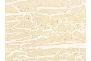 ABIN6262809 and ABIN6278267 at 1/100 staining human tongue carcinoma by IHC-P. (KIF3A Antikörper  (C-Term))
