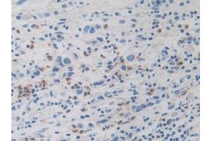 IHC-P analysis of Human Stomach cancer Tissue, with DAB staining. (Dopamine Receptor d1 Antikörper  (AA 338-446))