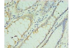 Immunohistochemistry of paraffin-embedded human colon cancer using ABIN7173555 at dilution of 1:100 (TMOD3 Antikörper  (AA 1-352))