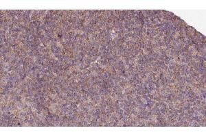 ABIN6273129 at 1/100 staining Human lymph cancer tissue by IHC-P. (KIF12 Antikörper  (N-Term))