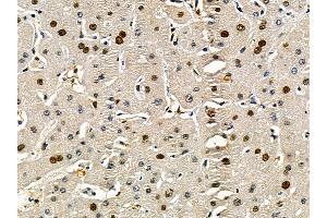 ABIN7095507 and ABIN7099564 at 1/100 staining human liver cancer by IHC-P. (CAND1 Antikörper)