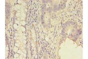 Immunohistochemistry of paraffin-embedded human colon cancer using ABIN7143981 at dilution of 1:100 (SCNN1G Antikörper  (AA 90-350))