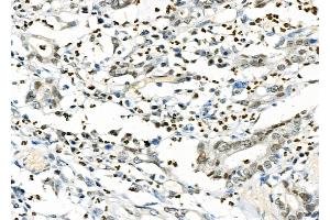 ABIN6261703 and ABIN6277266 at 1/100 staining Human gastric cancer by IHC-P. (CD16 Antikörper  (C-Term))