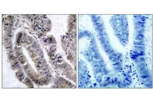 Immunohistochemical analysis of paraffin- embedded human colon carcinoma tissue, using AMPK1/AMPK2 (phospho-Ser485/Ser491) antibody (E011174). (PRKAA1/PRKAA2 Antikörper  (pSer485, pSer491))