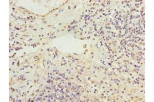 Immunohistochemistry of paraffin-embedded human cervical cancer using ABIN7168321 at dilution of 1:100 (RBMS2 Antikörper  (AA 1-407))