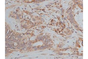ABIN6268647 at 1/50 staining human lung cancer tissue sections by IHC-P. (TSC1 Antikörper  (C-Term))