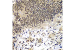 Immunohistochemistry of paraffin-embedded human colon carcinoma using CEBPG antibody (ABIN5974381) at dilution of 1/100 (40x lens). (CEBPG Antikörper)