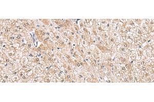 Immunohistochemistry of paraffin-embedded Human liver cancer tissue using HLA-E Polyclonal Antibody at dilution of 1:50(x200) (HLA-E Antikörper)