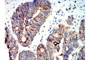 Immunohistochemical analysis of paraffin-embedded rectum cancer tissues using PRKAA2 mouse mAb with DAB staining. (PRKAA2 Antikörper  (AA 453-552))