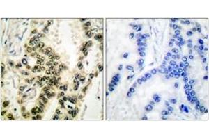 Immunohistochemistry analysis of paraffin-embedded human lung carcinoma, using SRF (Phospho-Ser99) Antibody. (SRF Antikörper  (pSer103))