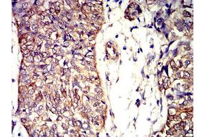 Immunohistochemical analysis of paraffin-embedded bladder cancer tissues using APC2 mouse mAb with DAB staining.