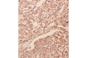 Anti-GDNF antibody, IHC(P) IHC(P): Human Lung Cancer Tissue (GDNF Antikörper  (Middle Region))