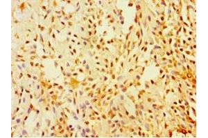 Immunohistochemistry of paraffin-embedded human breast cancer using ABIN7170920 at dilution of 1:100 (SUGCT Antikörper  (AA 1-250))