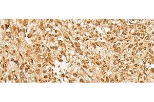 Immunohistochemistry of paraffin-embedded Human liver cancer tissue using JPT2 Polyclonal Antibody at dilution of 1:65(x200) (JPT2 Antikörper)
