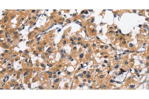 Immunohistochemistry of paraffin-embedded Human thyroid cancer tissue using CLEC2D Polyclonal Antibody at dilution 1:70 (CLEC2D Antikörper)