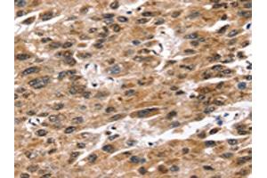 The image on the left is immunohistochemistry of paraffin-embedded Human liver cancer tissue using ABIN7192580(SNTA1 Antibody) at dilution 1/20, on the right is treated with synthetic peptide.