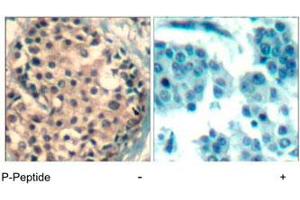 Immunohistochemical analysis of paraffin-embedded human breast carcinoma tissue using HDAC4/HDAC5/HDAC9 (phospho S246/259/220) polyclonal antibody . (HDAC4 Antikörper  (pSer220, pSer246, pSer259))