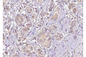 ABIN6274740 at 1/100 staining Human breast cancer tissue by IHC-P. (MRPL40 Antikörper  (C-Term))
