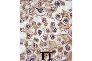 Formalin-fixed and paraffin-embedded human testis tissue reacted with INSRR polyclonal antibody  , which was peroxidase-conjugated to the secondary antibody, followed by DAB staining. (INSRR Antikörper  (N-Term))