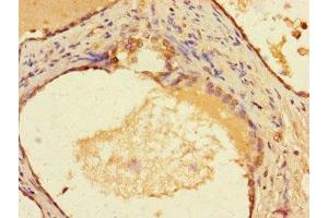 Immunohistochemistry of paraffin-embedded human prostate cancer using ABIN7155576 at dilution of 1:100