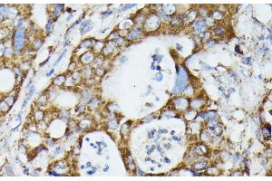 Immunohistochemistry of paraffin-embedded Human colon carcinoma using MTIF2 Polyclonal Antibody at dilution of 1:100 (40x lens). (MTIF2 Antikörper)