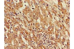 Immunohistochemistry of paraffin-embedded human liver cancer using ABIN7143803 at dilution of 1:100 (ST8SIA5 Antikörper  (AA 101-376))
