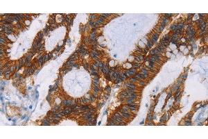 Immunohistochemistry of paraffin-embedded Human colon cancer using GPA33 Polyclonal Antibody at dilution of 1:30 (GPA33 Antikörper)