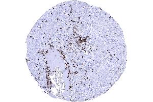Numerous MPO positive intravascular and stromal granulocytes are seen in a squamous cell carcinoma of the oral cavity (Myeloperoxidase Antikörper)